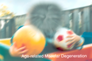 Age related Macular Degeneration Example