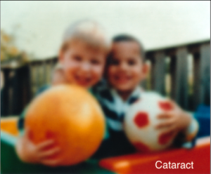 Cataract Example