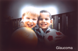 Glaucoma Example