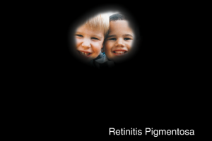 Retinitis Pigmentosa Example